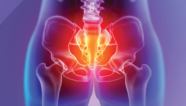 Chronic Pelvis Pain