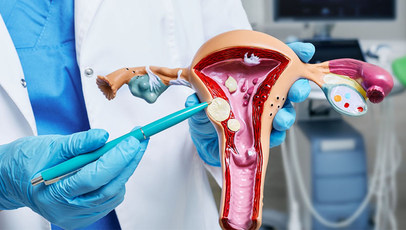 Uterine Fibroid